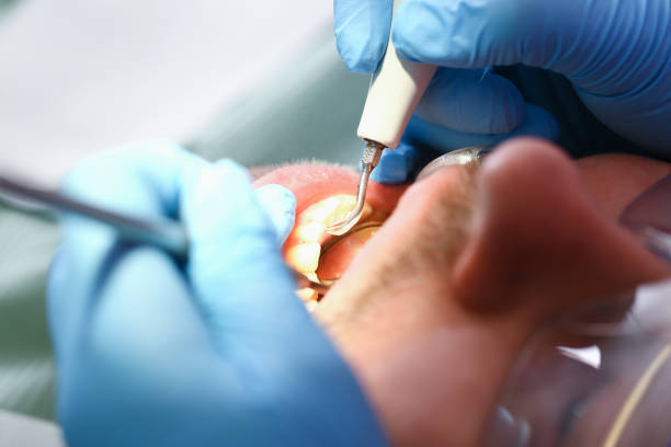 Best Emergency Tooth Extraction in Footville, WI